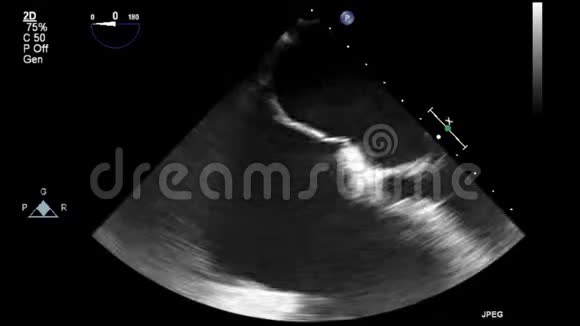 优质视频超声经食管检查心脏视频的预览图