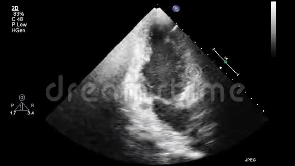 优质视频超声经食管检查心脏视频的预览图