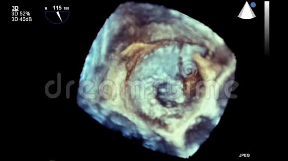 优质视频超声经食管检查心脏视频的预览图