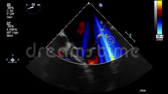 心脏超声经食管检查视频的预览图