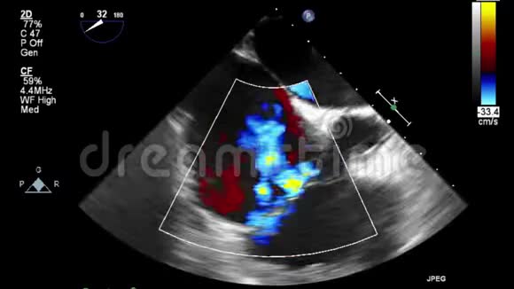心脏超声经食管检查视频的预览图