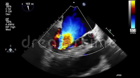 视频超声经食管心脏检查视频的预览图