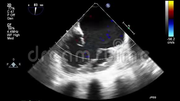 心脏超声经食管检查视频的预览图