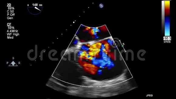 视频超声经食管心脏检查视频的预览图