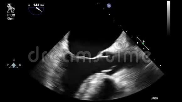 视频超声经食管心脏检查视频的预览图