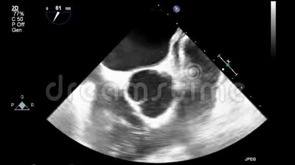 视频超声经食管心脏检查视频的预览图