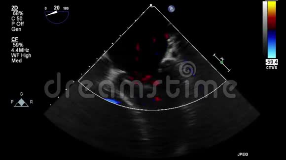 视频超声经食管心脏检查视频的预览图
