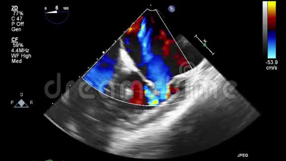 视频超声经食管心脏检查视频的预览图