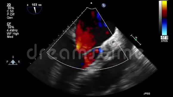 视频超声经食管心脏检查视频的预览图
