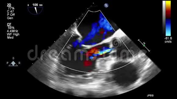 视频超声经食管心脏检查视频的预览图