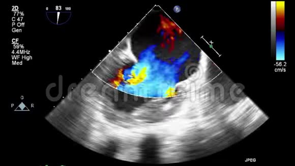 视频超声经食管心脏检查视频的预览图