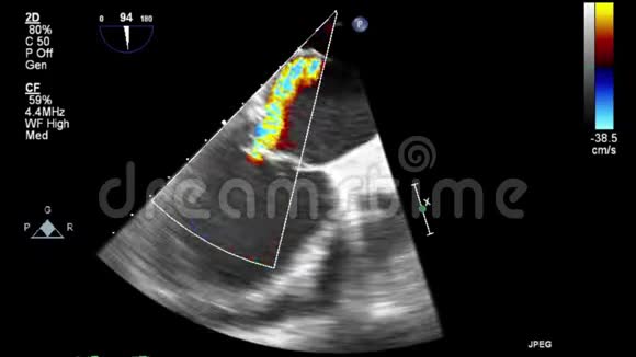视频超声经食管心脏检查视频的预览图