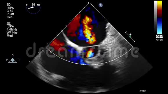 视频超声经食管心脏检查视频的预览图