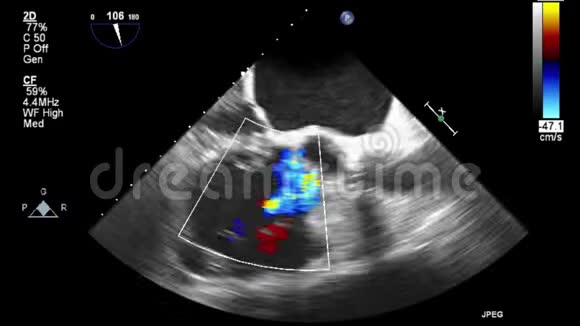 视频超声经食管心脏检查视频的预览图