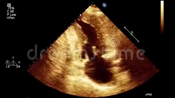 视频超声经食管心脏检查视频的预览图