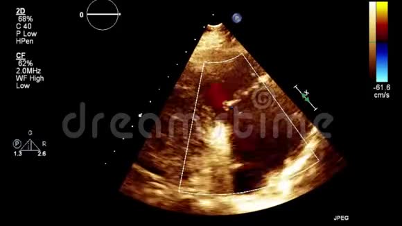视频超声经食管心脏检查视频的预览图