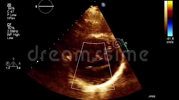 视频超声经食管心脏检查视频的预览图