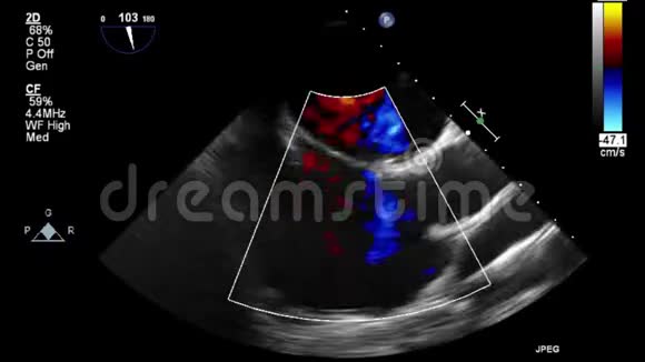 视频超声经食管心脏检查视频的预览图