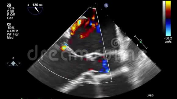 视频超声经食管心脏检查视频的预览图