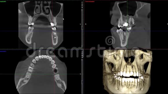 口腔医学牙科研究新质量医学牙科影像动画的人颌骨成像扫描视频的预览图