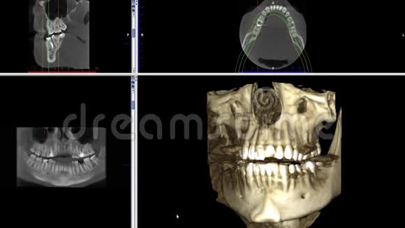 口腔医学牙科研究新质量医学牙科影像动画的人颌骨成像扫描视频的预览图