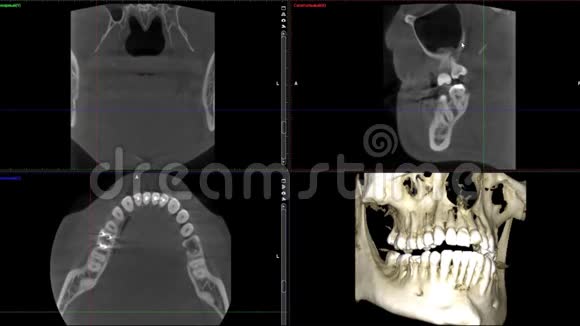 口腔医学牙科研究新质量医学牙科影像动画的人颌骨成像扫描视频的预览图