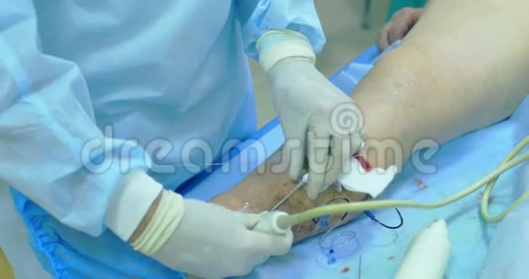 静脉曲张手术的创新方法硬化治疗程序病人腿部特写镜头视频的预览图
