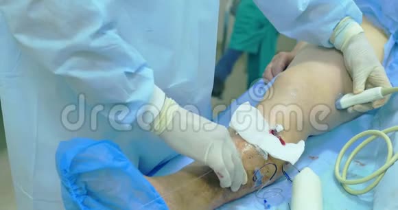 静脉曲张手术的创新方法硬化治疗程序病人腿部特写镜头视频的预览图