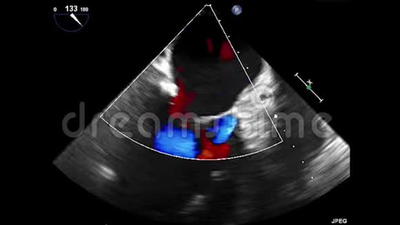 经食管超声超声心动图视频的预览图
