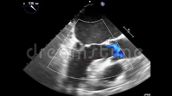 经食管超声超声心动图视频的预览图