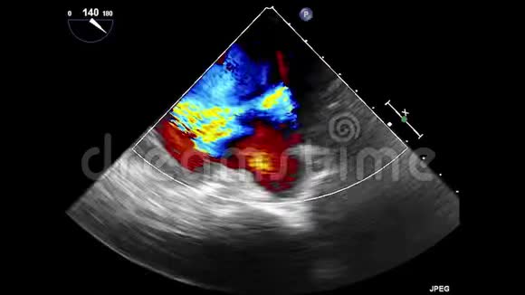 经食管超声超声心动图视频的预览图