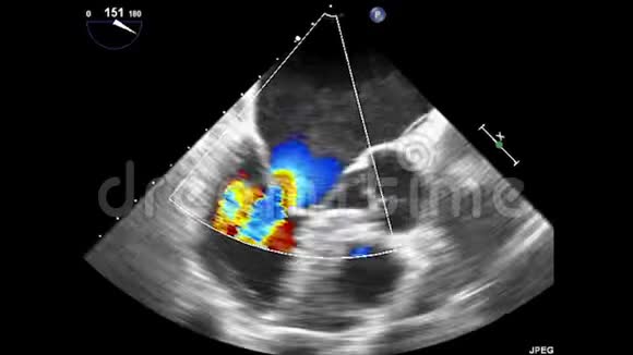 经食管超声超声心动图视频的预览图