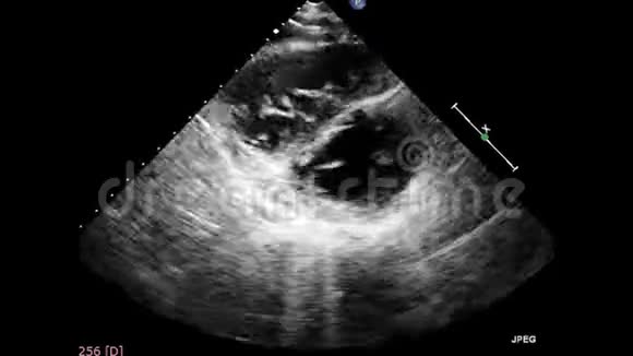 经食管超声超声心动图视频的预览图