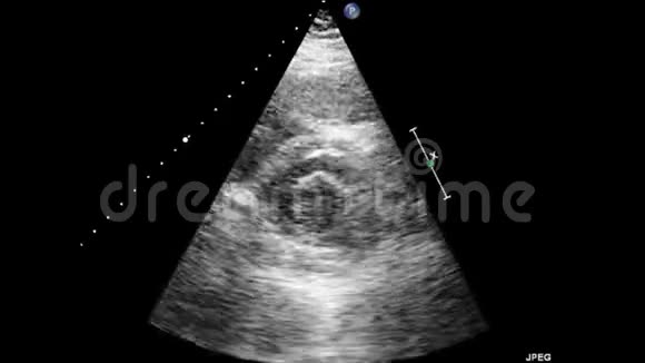 经食管超声超声心动图视频的预览图