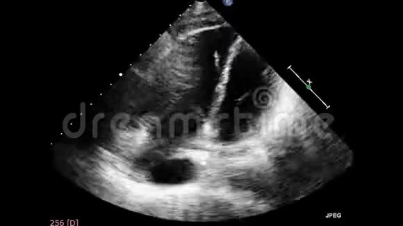 经食管超声超声心动图视频的预览图