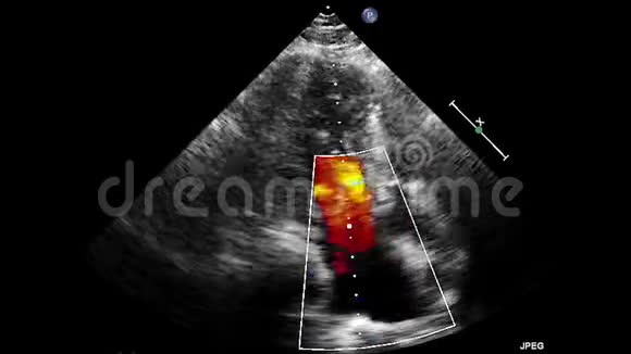 经食管超声超声心动图视频的预览图