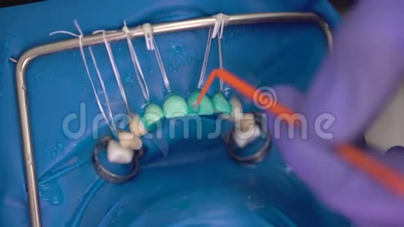 诊所牙科安装贴面给病人在牙科诊所牙医美牙微笑关门视频的预览图