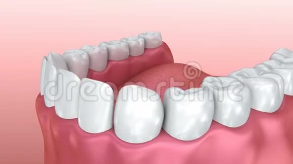 口胶和牙齿医学上精确的牙齿视频的预览图