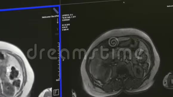 核磁共振扫描的脑部断层扫描视频的预览图