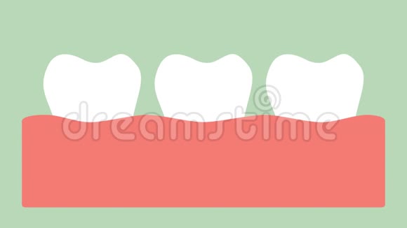 牙龈炎或牙龈疾病前的牙龈斑块视频的预览图