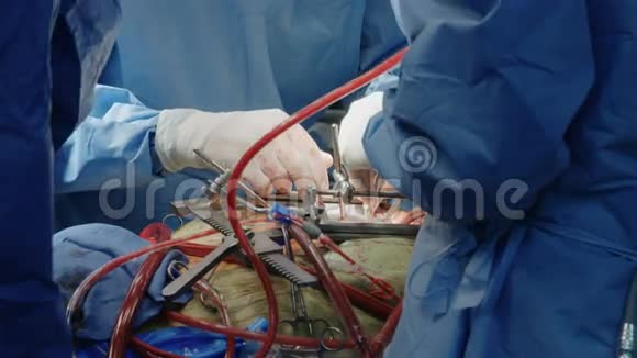 心脏手术期间的外科医生视频的预览图