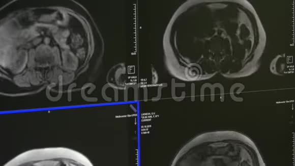 核磁共振扫描专业医疗设备上的脑部断层扫描视频的预览图