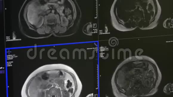 核磁共振扫描专业医疗设备上的脑部断层扫描视频的预览图