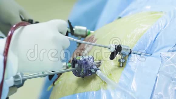 腹腔镜手术患者腹部视频的预览图