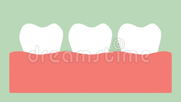 牙龈炎或牙龈疾病伴有出血牙周病前牙龈发炎视频的预览图