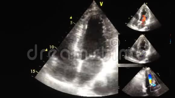 心脏超声超声检查视频的预览图