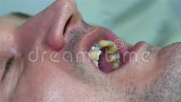 牙科植入术视频的预览图