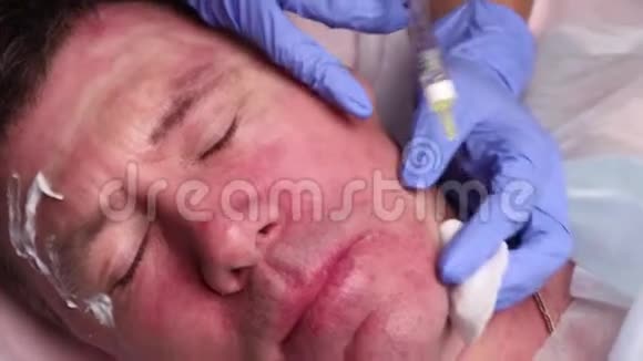 医生在病人脸上划了一个穴位注射生物资本化的准备接近视频的预览图