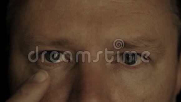 闭眼男性眼睑及角膜发红结膜炎活动迟缓视频的预览图