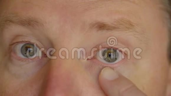 闭眼男性眼睑及角膜发红结膜炎视频的预览图